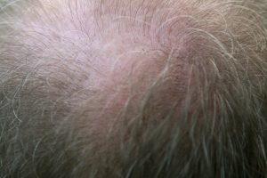 thinning hair